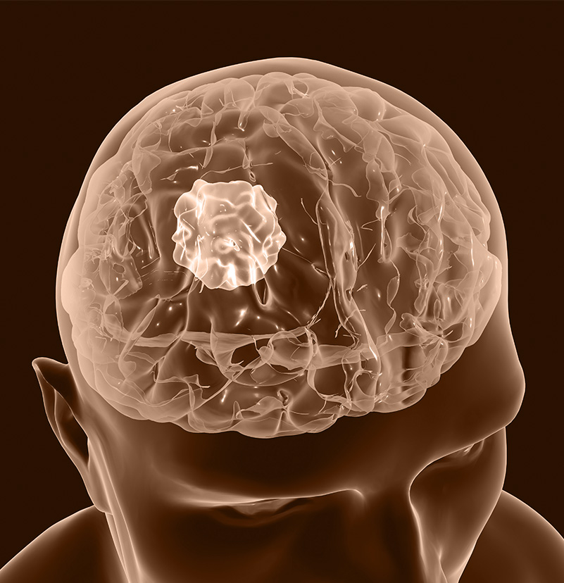 Neurological Conditions - Neurosurgeon | Cape Town, South Africa