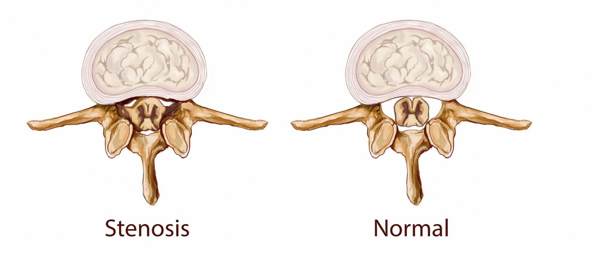 Spinal Conditions - Neurosurgeon | Cape Town, South Africa