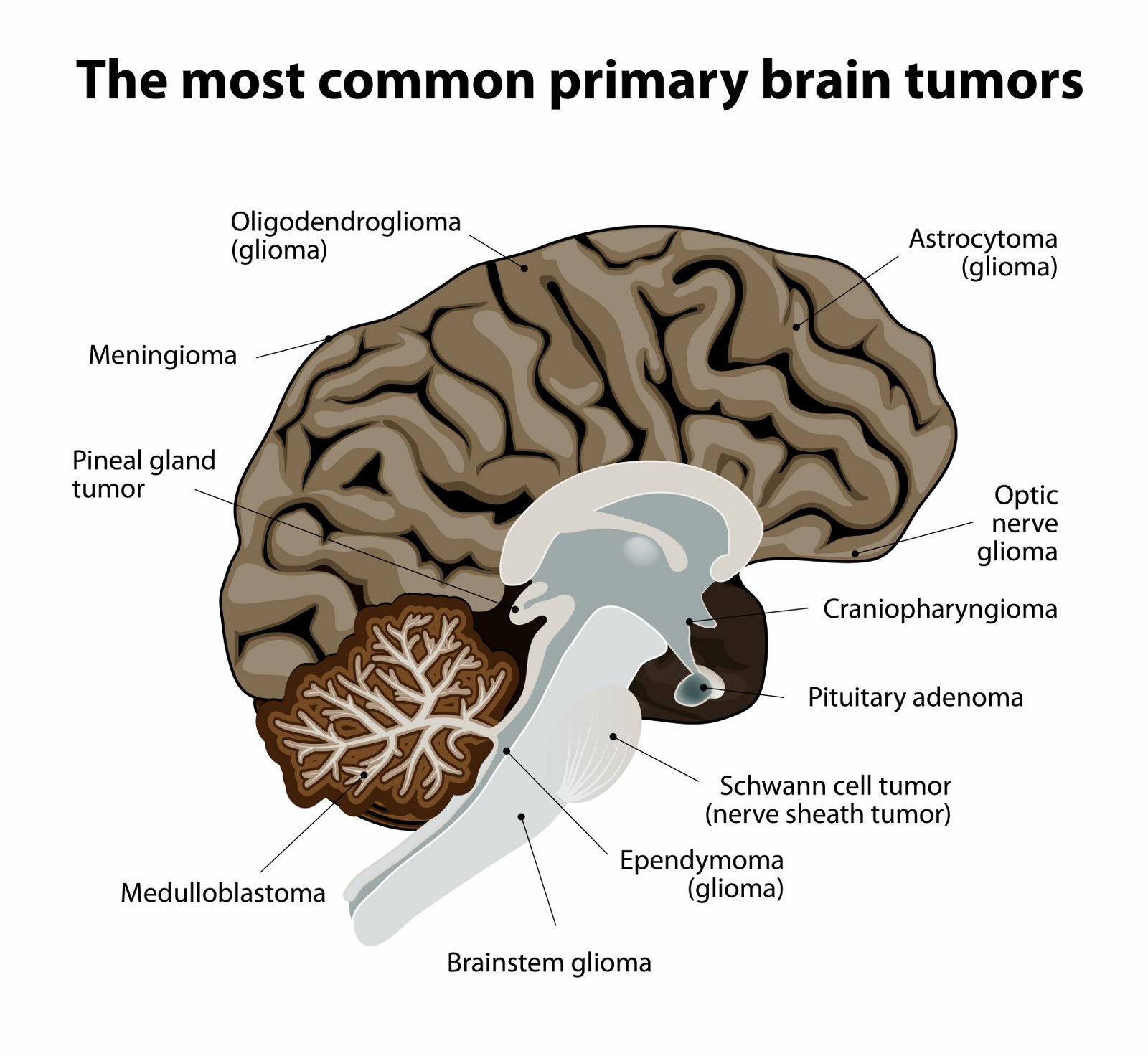 brain tumor (1)