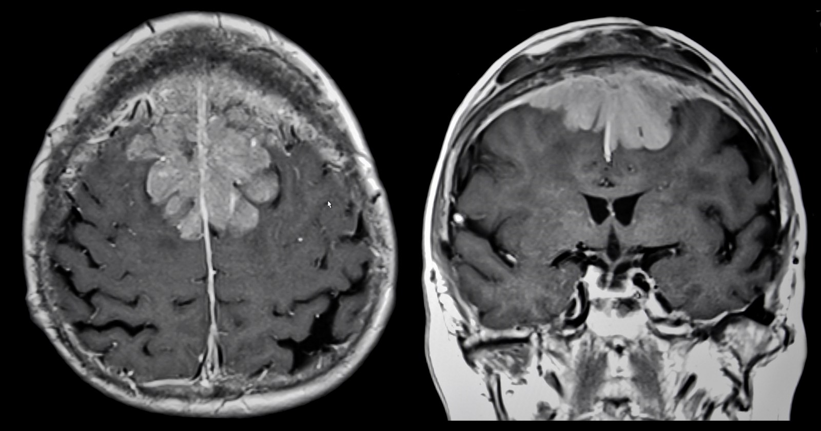 brain tumor (2)