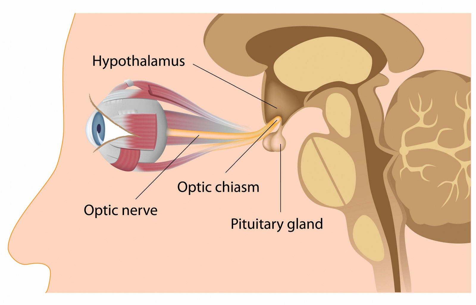 brain tumor (3)