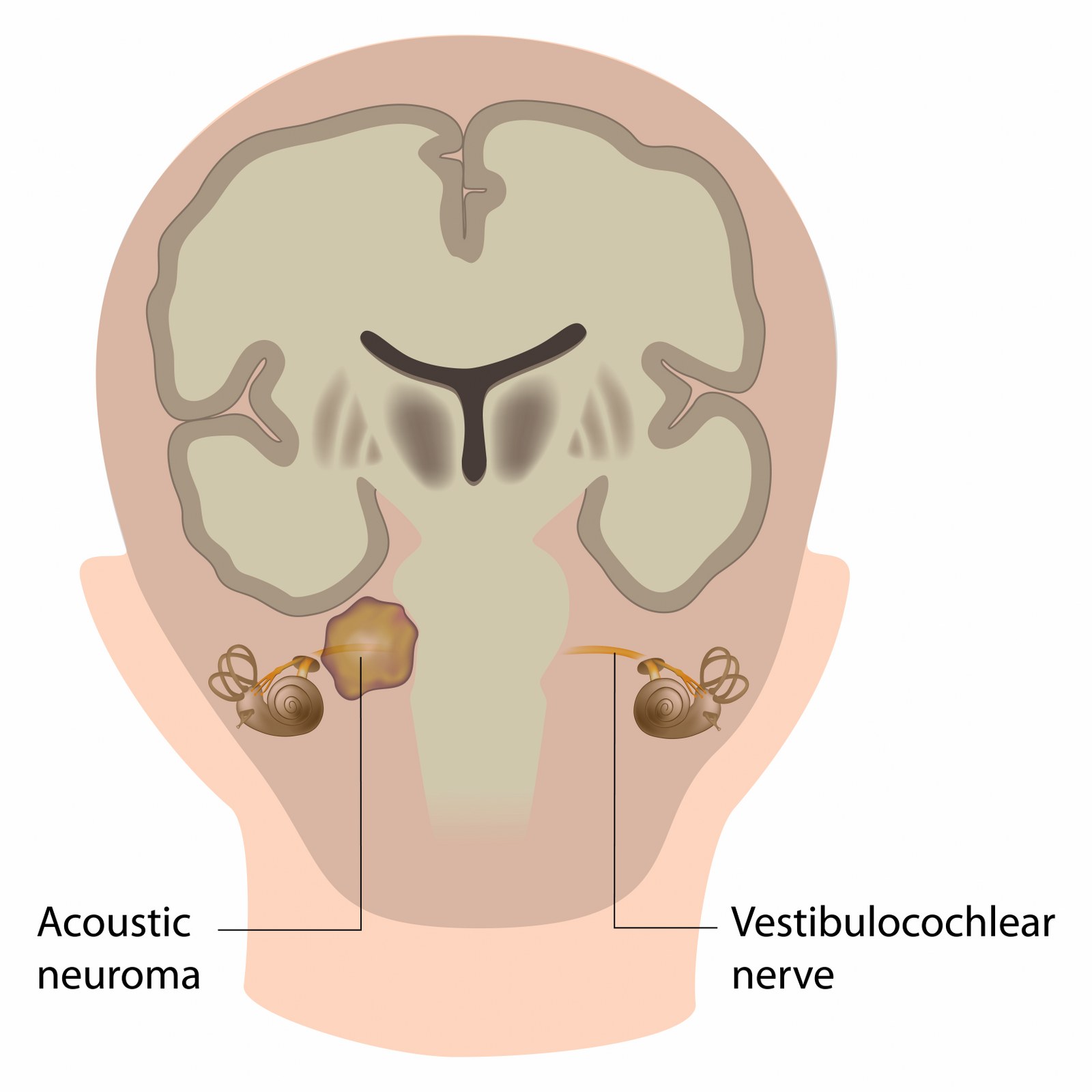brain tumor (4)