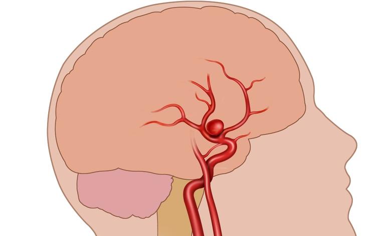 cerebral (1)